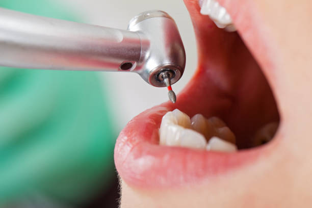 Best Chipped Tooth Repair Near Me  in Moores Mill, AL